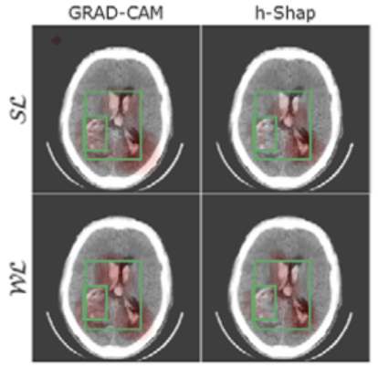 Examination-level supervision for deep learning–based intracranial hemorrhage detection at head CT