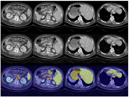 Conformal Risk Control for Semantic Uncertainty Quantification in Computed Tomography
